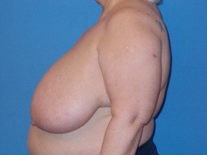 Breast Reduction Patient 2 - Before