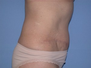 Abdominoplasty Patient 5 - After