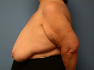 Breast Reduction Patient 5 - Before