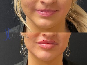 Lip filler injection before & after 1 syringe of Juvederm with chin filler