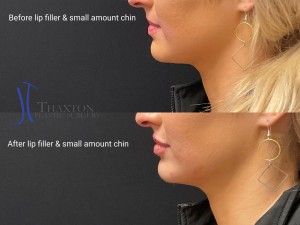 lip filler injection before after