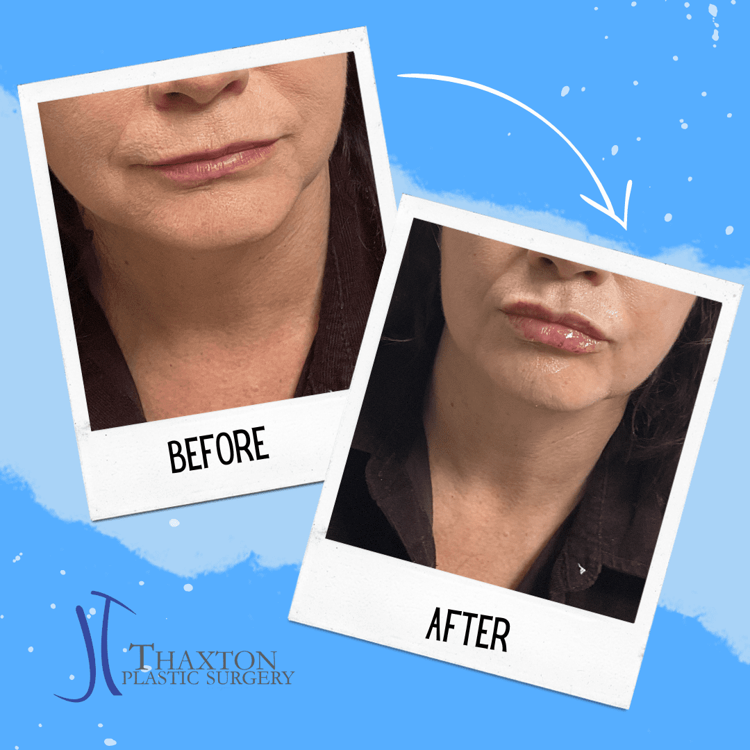 Lip Filler Lip injections in Charleston, WV Thaxton Plastic Surgery