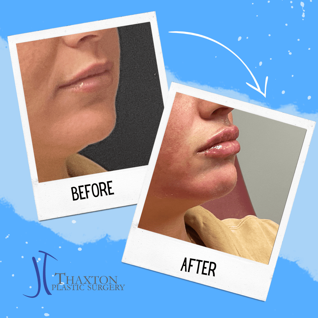 Lip Filler Lip injections in Charleston, WV Thaxton Plastic Surgery