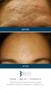 microneedling result