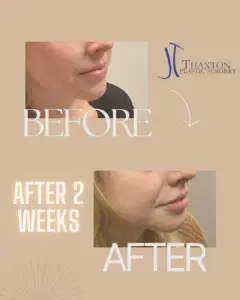 Lip filler injections Charleston WV before after