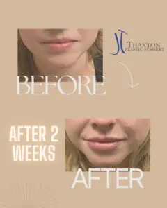 Lip filler injections before & after 2 weeks