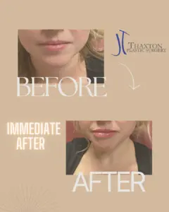 Lip filler injections Charleston WV