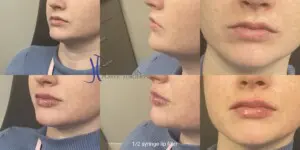 dr rebecca thaxton Lip filler before after