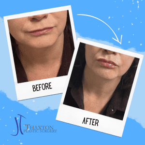 lip filler injection Charleston WV