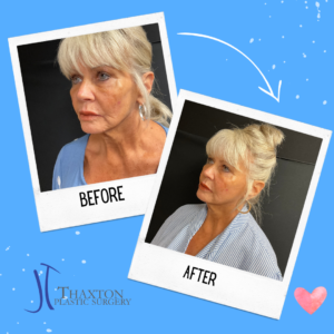 Face filler injections Charleston WV before after