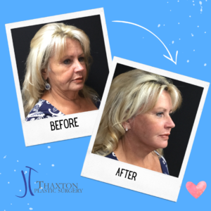 facelift before after charleston wv