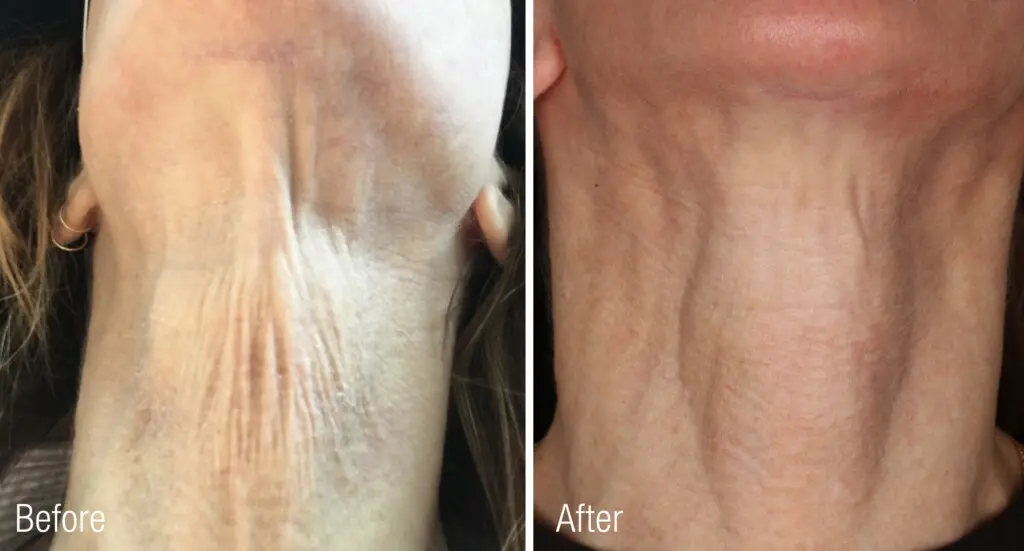 dermal fillers renuva before after