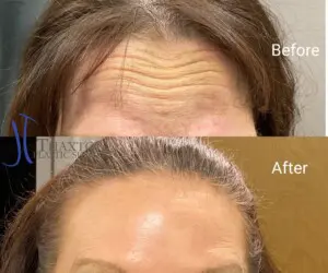 Botox near Teays Valley WV