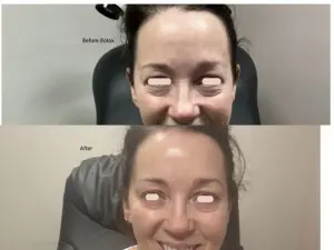 Botox before and after