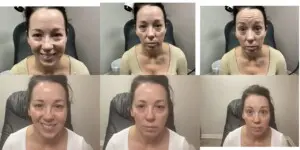 Botox before after