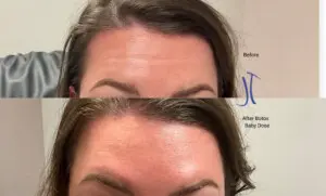Baby Botox
