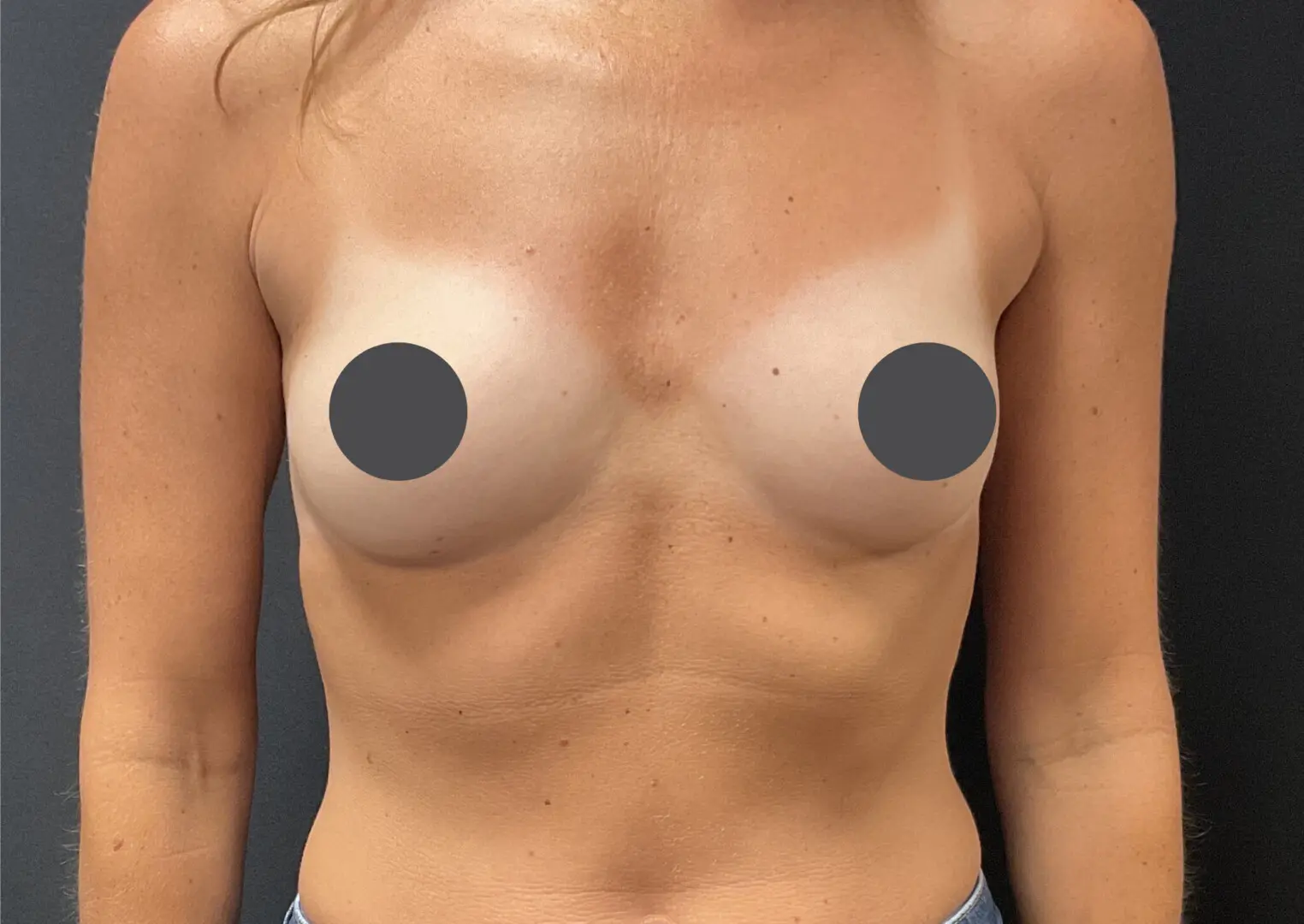 Breast Augmentation Before after 1 before