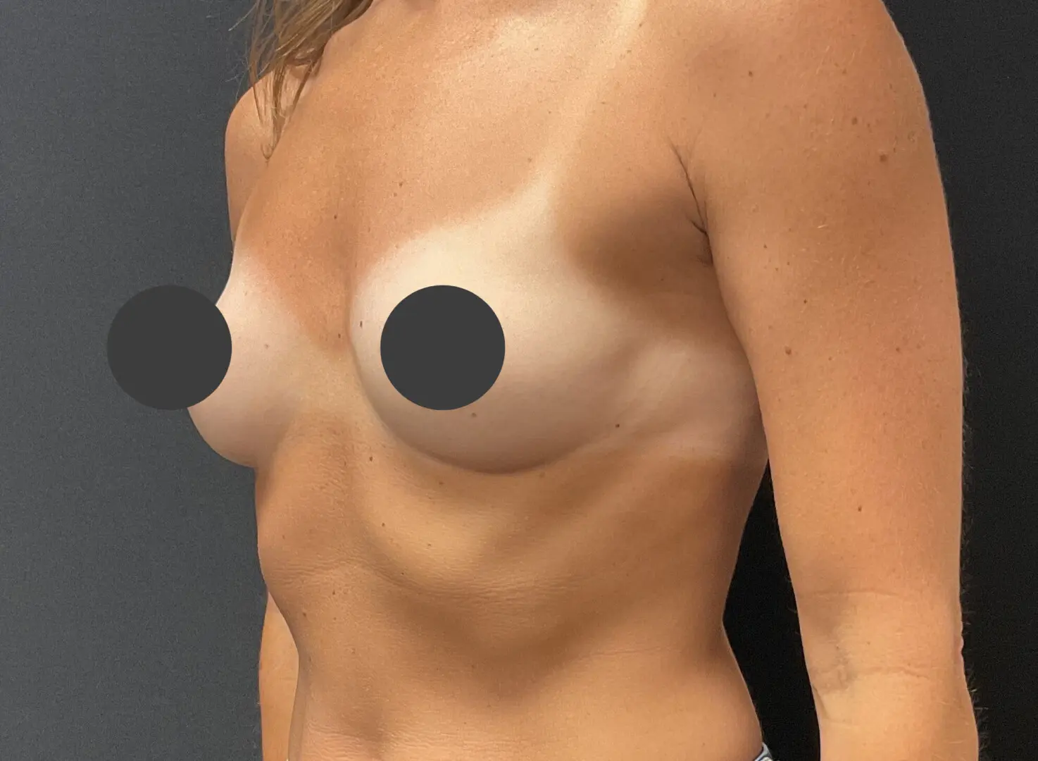 Jeff Thaxton MD Breast Augmentation Result with 520 CC Implants