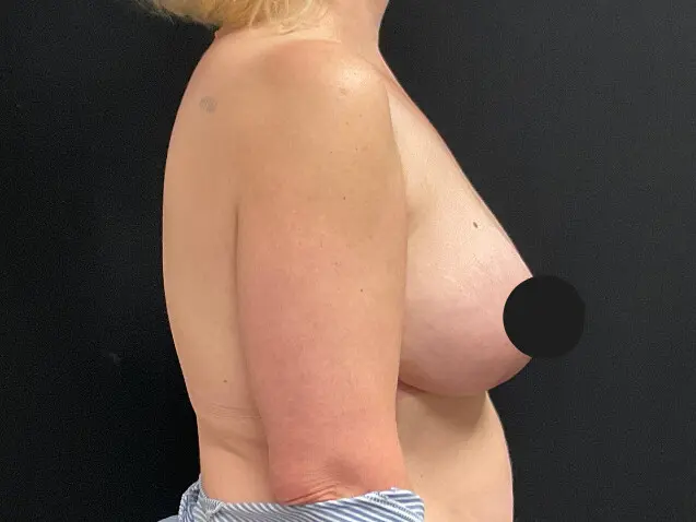 Breast Augmentation before and after