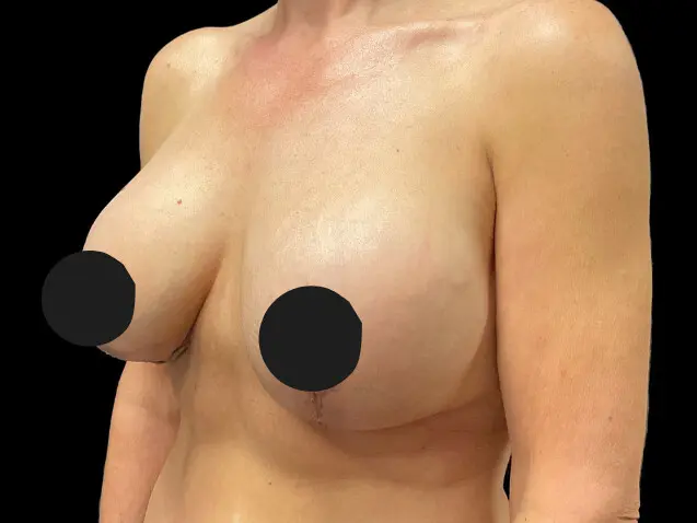 Breast Augmentation before and after
