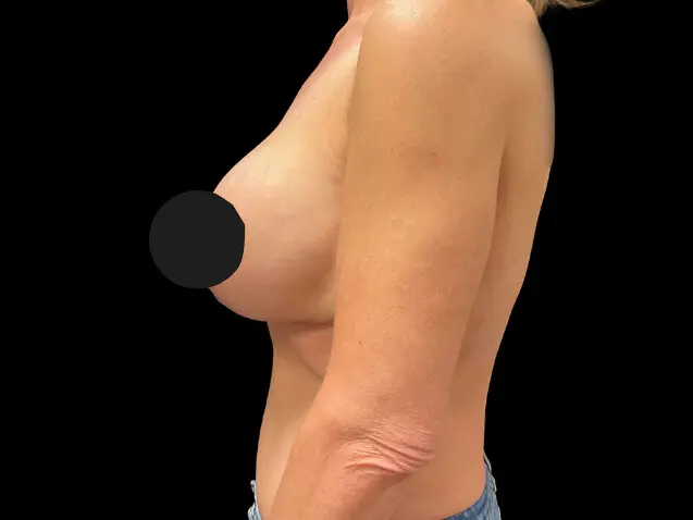 Breast Augmentation before and after