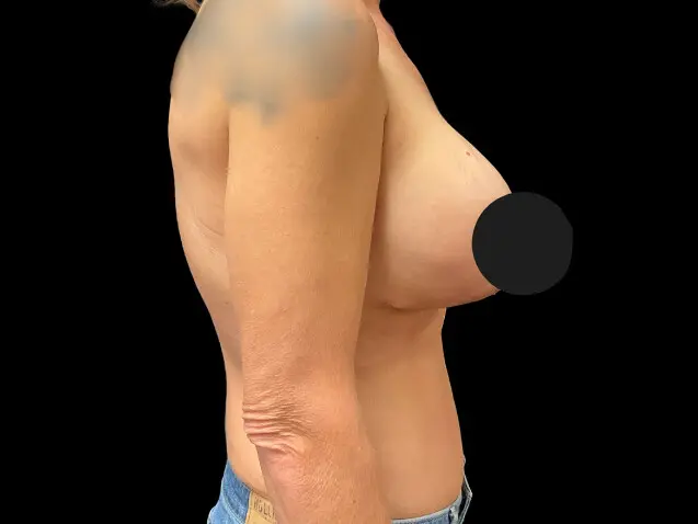 Breast Augmentation before and after