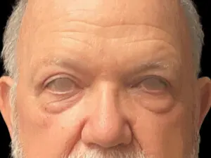 Jeff Thaxton MD Blepharoplasty Result