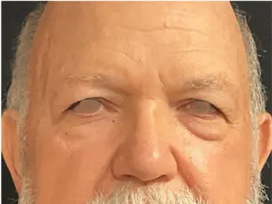 Jeff Thaxton MD Blepharoplasty Result