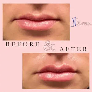 Jeff Thaxton MD Lip Filler result Patient 1