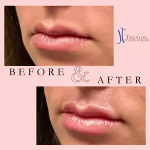 Jeff Thaxton MD Lip Filler result Patient 1