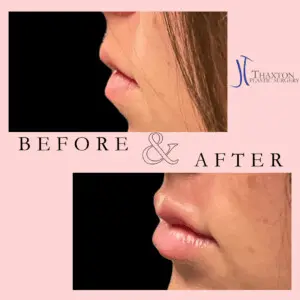 Jeff Thaxton MD Lip Filler result Patient 1