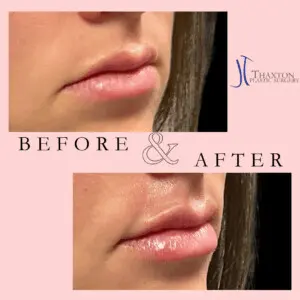 Jeff Thaxton MD Lip Filler result Patient 1