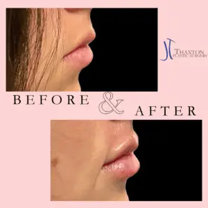 Jeff Thaxton MD Lip Filler result Patient 1