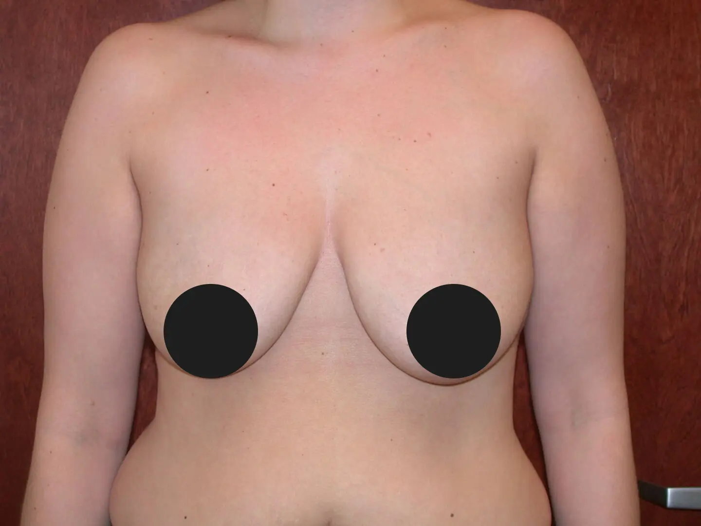 Jeff Thaxton MD breast aug lift surgery after 370 cc breast implants before facing L