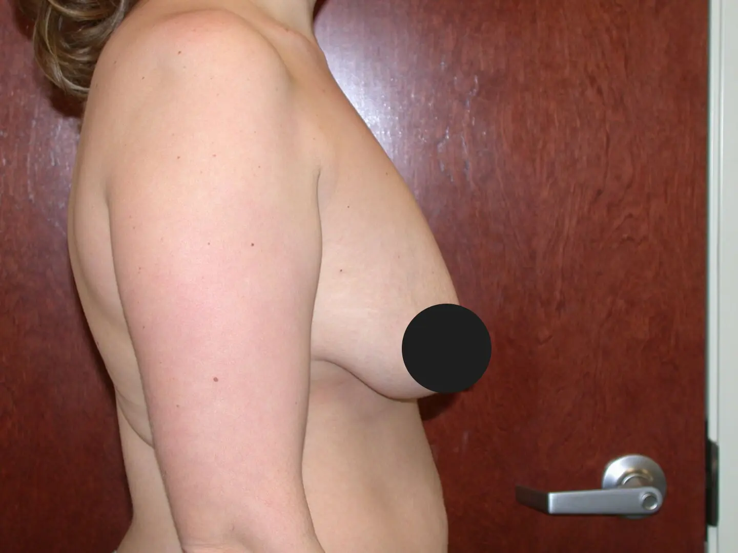 Jeff Thaxton MD breast lift surgery before