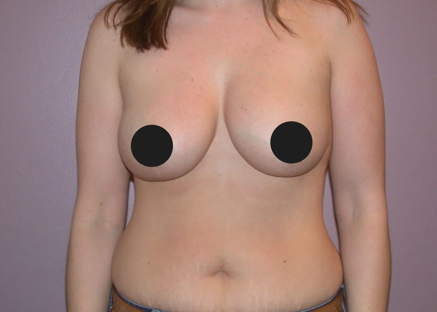 Jeff Thaxton MD breast aug lift surgery after 370 cc breast implants