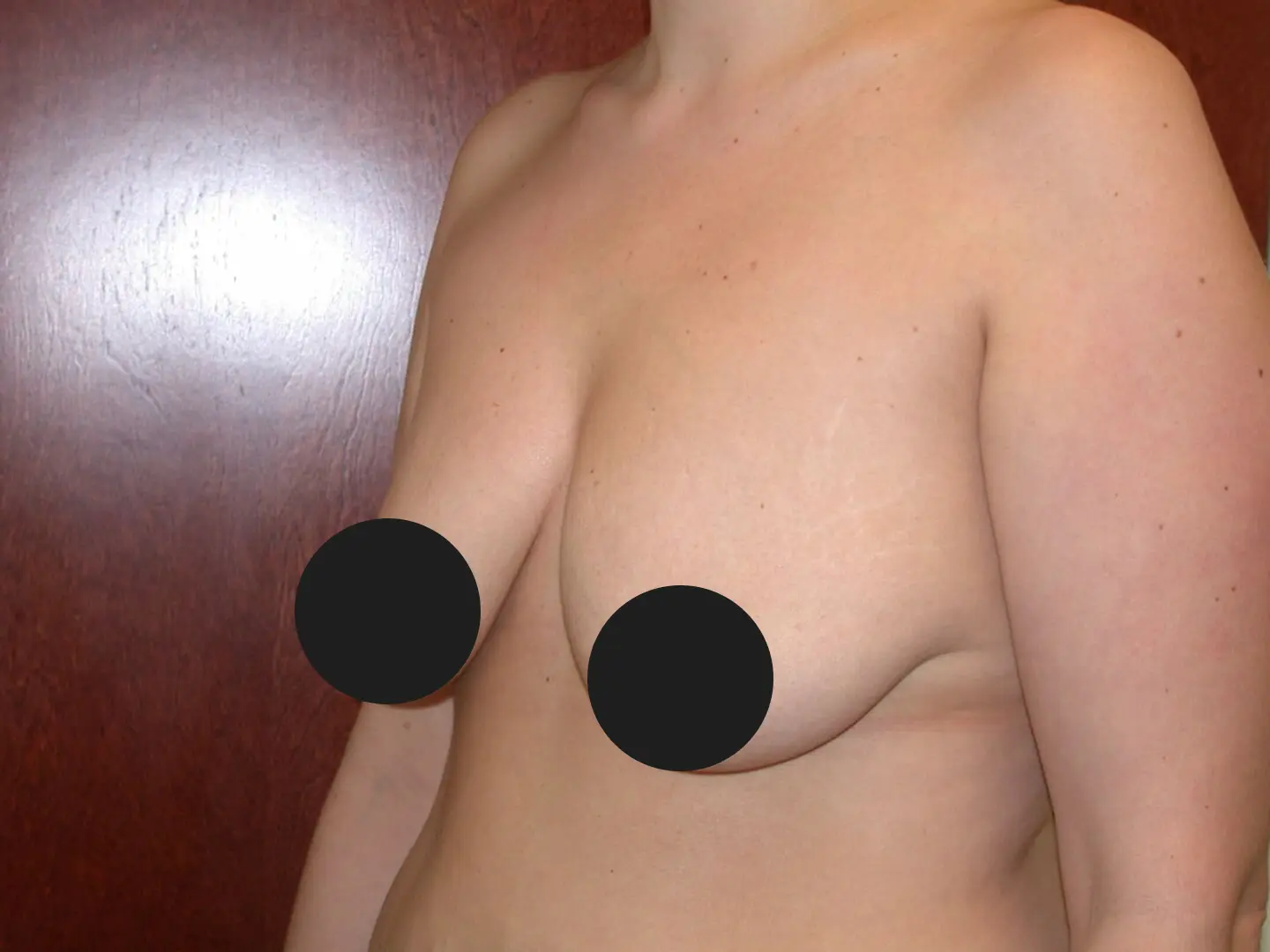Jeff Thaxton MD breast aug lift surgery before 370 cc breast implants before 4
