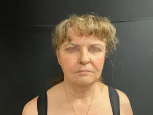 Jeff Thaxton MD Brow Lift Result