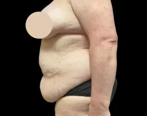 Jeff Thaxton MD Tummy Tuck Result