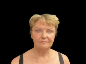 Jeff Thaxton MD Brow Lift Result