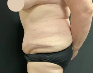 Jeff Thaxton MD Tummy Tuck Result
