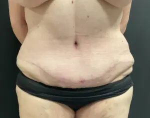 Jeff Thaxton MD Tummy Tuck Result