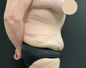 Jeff Thaxton MD Tummy Tuck Result