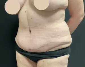 Jeff Thaxton MD Tummy Tuck Result