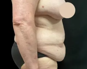 Jeff Thaxton MD Tummy Tuck Result