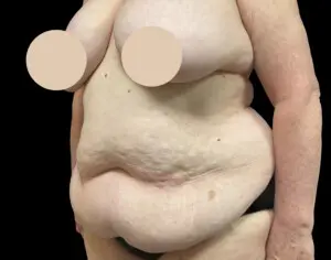 Jeff Thaxton MD Tummy Tuck Result