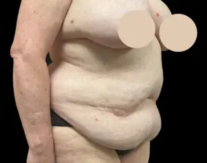 Jeff Thaxton MD Tummy Tuck Result