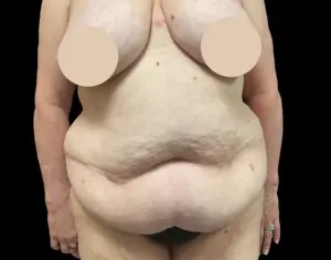 Jeff Thaxton MD Tummy Tuck Result