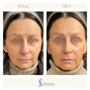 Dr. Jeff Thaxton Face Filler Result