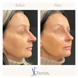 Dr. Jeff Thaxton Face Filler Result